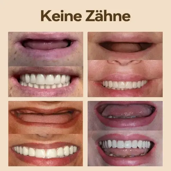 𝐇𝐢𝐝𝐨𝐧𝐞®🚀 – 🦷𝐏𝐫𝐞𝐦𝐢𝐮𝐦 𝐆𝐞𝐛𝐢𝐬𝐬🦷(✨Geeignet für alle Mundformen, speziell angefertigte Zahnersätze für die perfekte Passform✨)