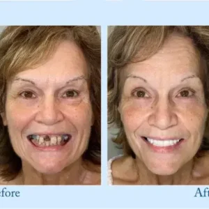 𝐇𝐢𝐝𝐨𝐧𝐞® 🦷Advanced Customized Full Denture Set🦷 (⏰Limited time discount last 30 minutes⏰)💎