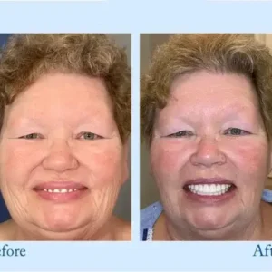 𝐇𝐢𝐝𝐨𝐧𝐞® 🦷Advanced Customized Full Denture Set🦷 (⏰Limited time discount last 30 minutes⏰)💎