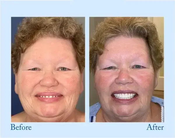 𝐇𝐢𝐝𝐨𝐧𝐞® 🦷Advanced Customized Full Denture Set🦷 (⏰Limited time discount last 30 minutes⏰)💎