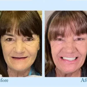 𝐇𝐢𝐝𝐨𝐧𝐞® 🦷Advanced Customized Full Denture Set🦷 (⏰Limited time discount last 30 minutes⏰)💎