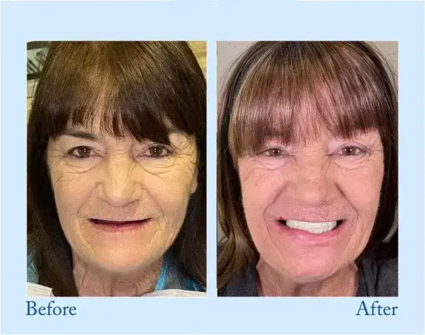 𝐇𝐢𝐝𝐨𝐧𝐞® 🦷Advanced Customized Full Denture Set🦷 (⏰Limited time discount last 30 minutes⏰)💎