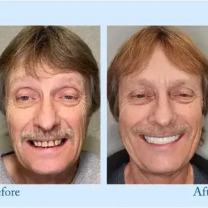 𝐇𝐢𝐝𝐨𝐧𝐞® 🦷Advanced Customized Full Denture Set🦷 (⏰Limited time discount last 30 minutes⏰)💎