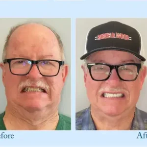 𝐇𝐢𝐝𝐨𝐧𝐞® 🦷Advanced Customized Full Denture Set🦷 (⏰Limited time discount last 30 minutes⏰)💎