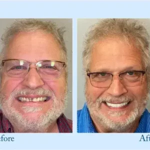 𝐇𝐢𝐝𝐨𝐧𝐞® 🦷Advanced Customized Full Denture Set🦷 (⏰Limited time discount last 30 minutes⏰)💎