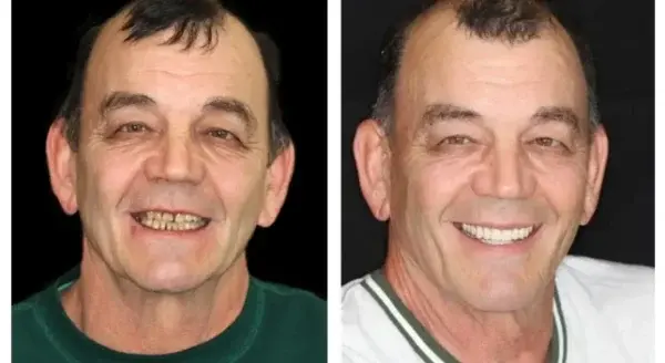 𝐁𝐢𝐤𝐞𝐧𝐝𝐚® –🦷Advanced Customized Full Denture Set🦷🇺🇸 (⏰Limited time discount last 30 minutes⏰)