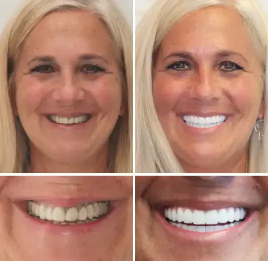 𝐁𝐢𝐤𝐞𝐧𝐝𝐚® –🦷Advanced Customized Full Denture Set🦷🇺🇸 (⏰Limited time discount last 30 minutes⏰)