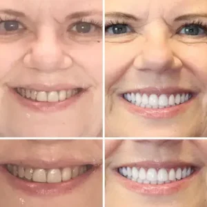 𝐁𝐢𝐤𝐞𝐧𝐝𝐚® –🦷Advanced Customized Full Denture Set🦷🇺🇸 (⏰Limited time discount last 30 minutes⏰)