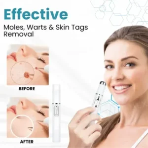 Bikenda® Non-Invasive Mole and Wart Removal Laser Pen