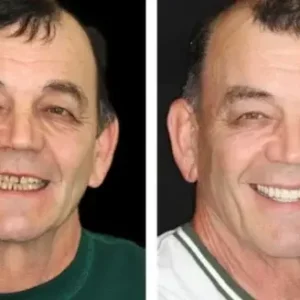 Hidone® Full Denture Set🦷🦷💃Advanced Self-Adjusting Dental Materials (⏰Limited time discount last 30 minutes⏰)