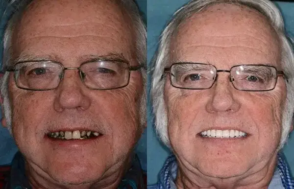 Hidone® Full Denture Set🦷🦷💃Advanced Self-Adjusting Dental Materials (⏰Limited time discount last 30 minutes⏰)