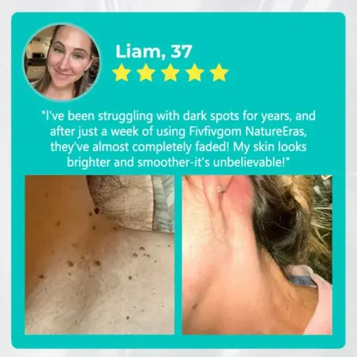 LOVILDS™ NatureErase Instant Mole & Spot Removal Gel