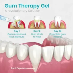 NESLEMY™ Gum Shield Therapy Gel 2025