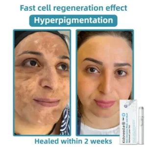 𝑲i𝒅sn𝒆𝒆𝒅® 𝑵on-i𝒏va𝒔𝒊ve 𝑴o𝒍e an𝒅 𝑾ar𝒕 𝑹emo𝒗𝒂𝒍 𝑳ase𝒓 𝑷en