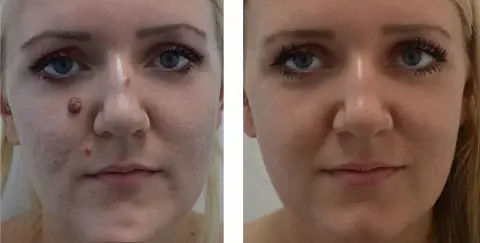 Lenaro™ Bee Venom Mole and Wart Treatment Cream