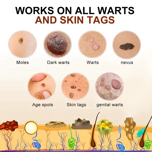 Lenaro™ Bee Venom Mole and Wart Treatment Cream