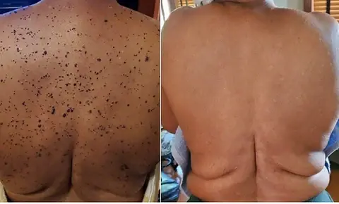 Lenaro™ Bee Venom Mole and Wart Treatment Cream