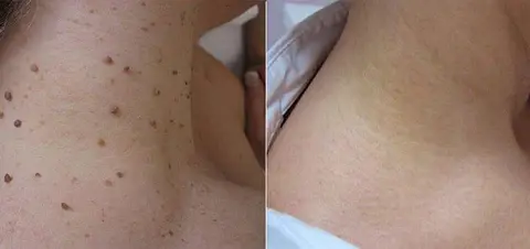 Lenaro™ Bee Venom Mole and Wart Treatment Cream