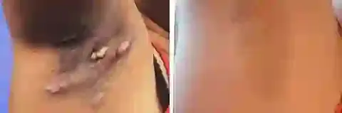 Lenaro™ Bee Venom Mole and Wart Treatment Cream