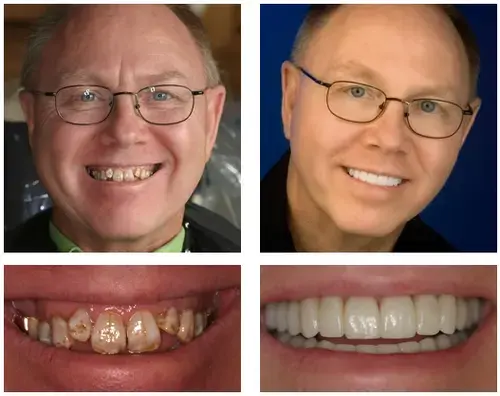 NESLEMY™ Custom-Fit Functional Dentures Smile with Confidence