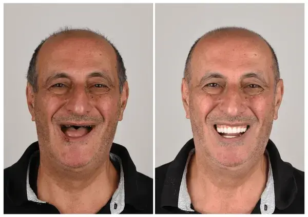 NESLEMY™ Custom-Fit Functional Dentures Smile with Confidence